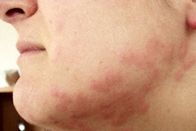 Alergická reakcia na uštipnutie plošticou posteľnou